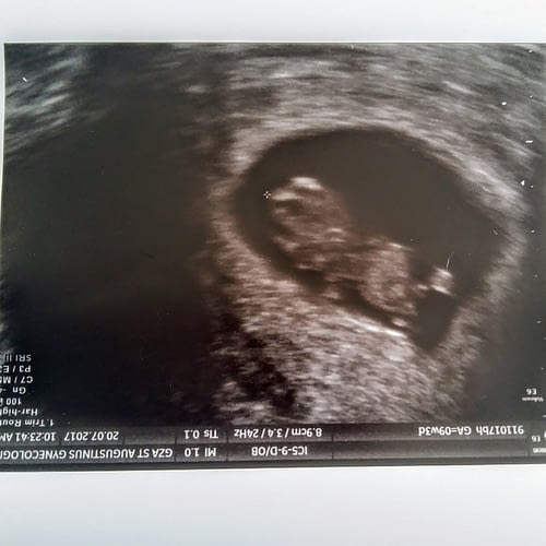 Ellis' eerste echo. Even later werd de NIP test uitgevoerd.
