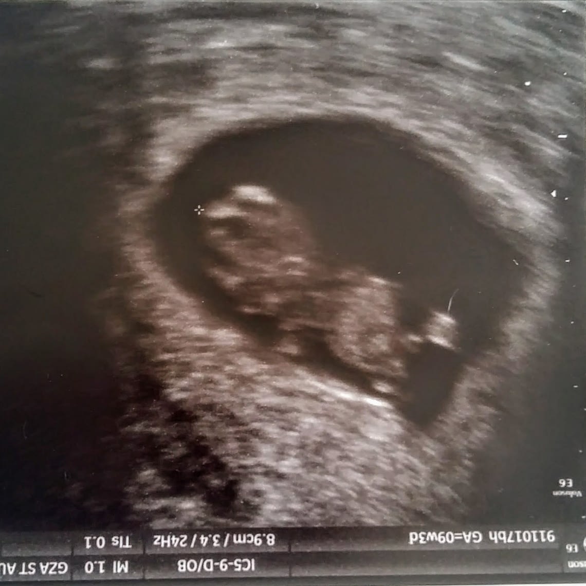 Ellis' eerste echo. Even later werd de NIP test uitgevoerd.